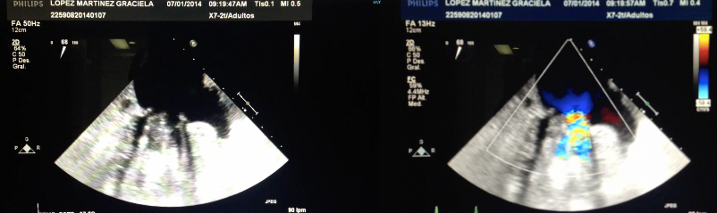 Ecocardiograma doppler