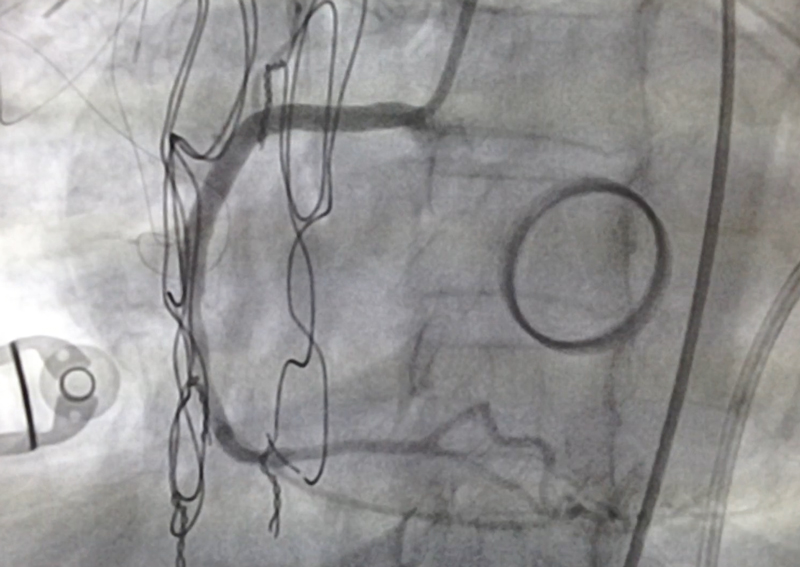 Angioplastia a coronaria derecha