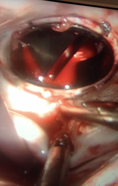 Prótesis mitral
