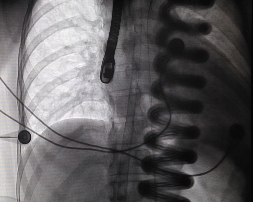 Canulación guiada por fluoroscopia
