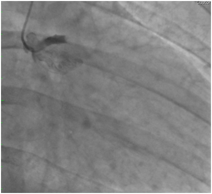 Angiografía muestra oclusión de TCI distal