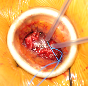 acceso transapical