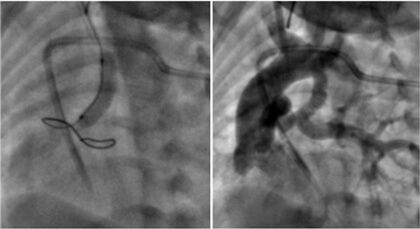 Figura 2. Implante de stent ductal por abord